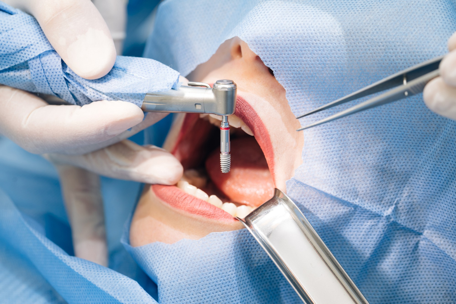Prótesis sobre implantes dentales ¿Qué tipos hay y cómo son?